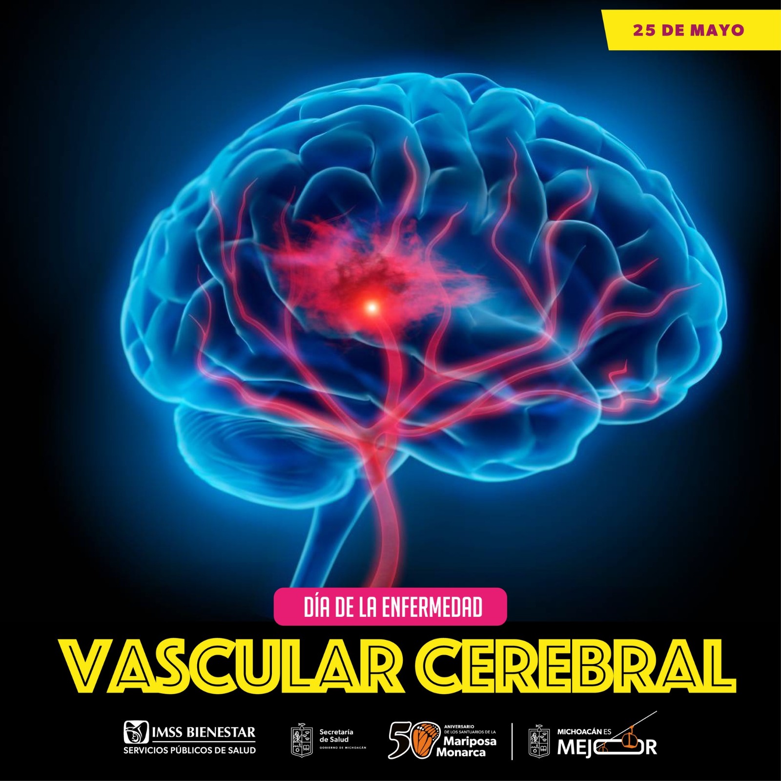 Cómo identificar signos de alarma de una enfermedad vascular cerebral: SSM Cómo identificar signos de alarma de una enfermedad vascular cerebral: SSM